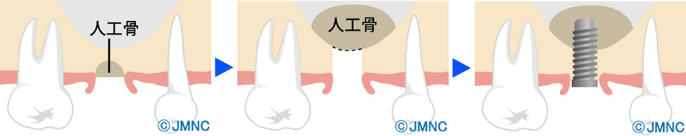 ソケットリフト