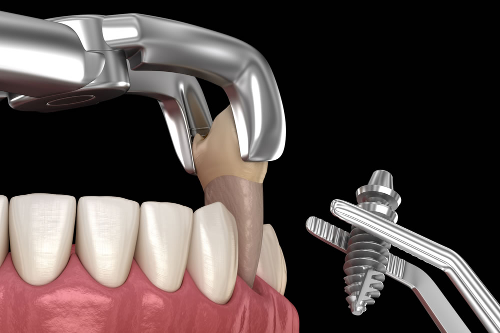抜歯即時埋入インプラントとは？
