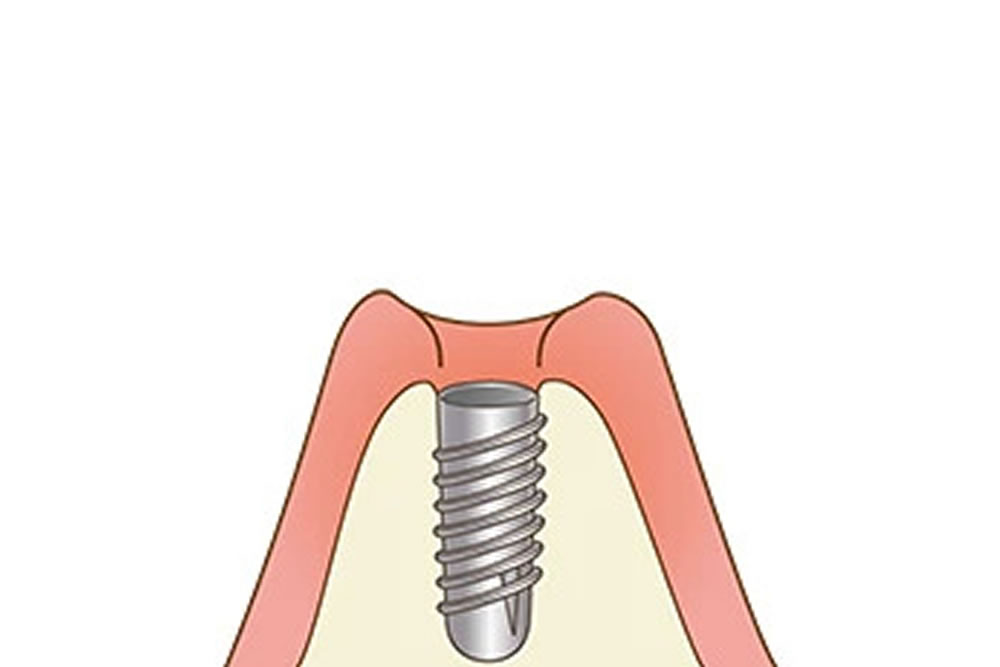 インプラント体（フィクスチャー）