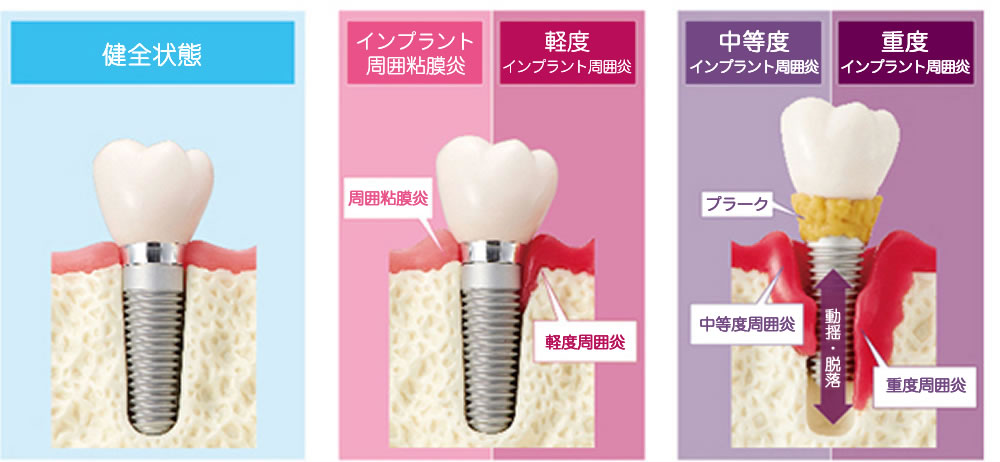 インプラント周囲炎